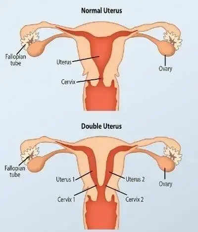 Two Vulvas Condition